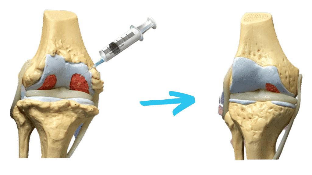 Stem cell treatment for cartilage damage schematic